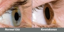 Kornea Dikleşmesi Belirtileri ve Tedavisi