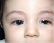 Bebeklerde Kornea Çizilmesi Tedavisi