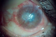 Kornea Apsesi Belirtileri ve Tedavisi