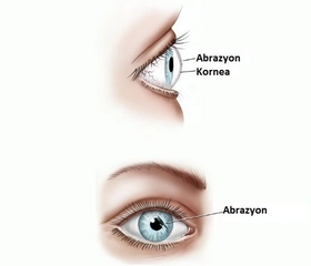Kornea Abrazyonu Belirtileri ve Tedavisi